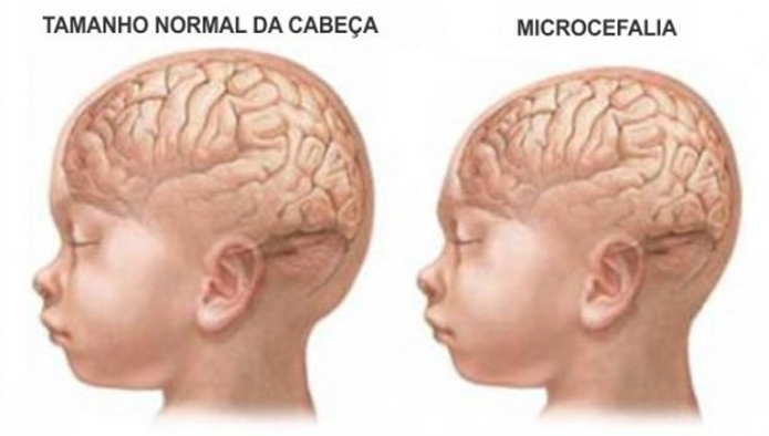 Ministério da Saúde confirma 18 casos de microcefalia em Rondônia