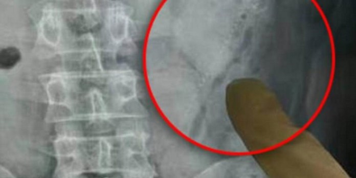BÊBADO: HOMEM COLOCA 02 PEIXES NO ÂNUS E UM DELES NADA ATÉ O ABDOMEN