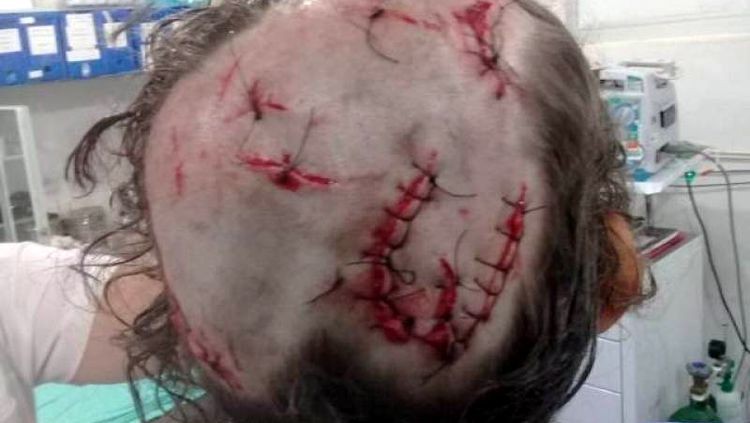 BESTA-FERA: Menina de 8 anos é atacada por pit bull na casa da irmã