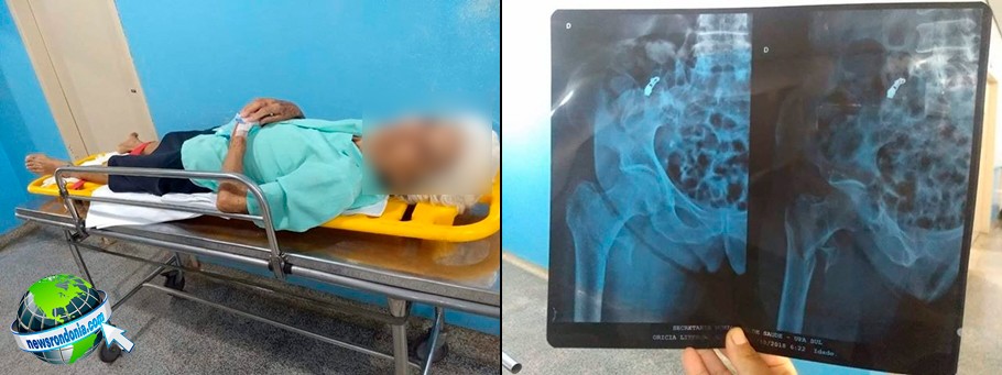 IDOSA DE 80 ANOS QUEBRA A PERNA AO SER ATROPELADA E FAMÍLIA PRECISA PAGAR AMBULÂNCIA PARA TRANSFERÊNCIA AO JOÃO PAULO II