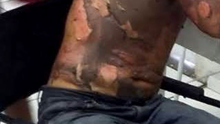 BÁRBARO: Mulher coloca fogo no marido dormindo por ciúmes de outro homem
