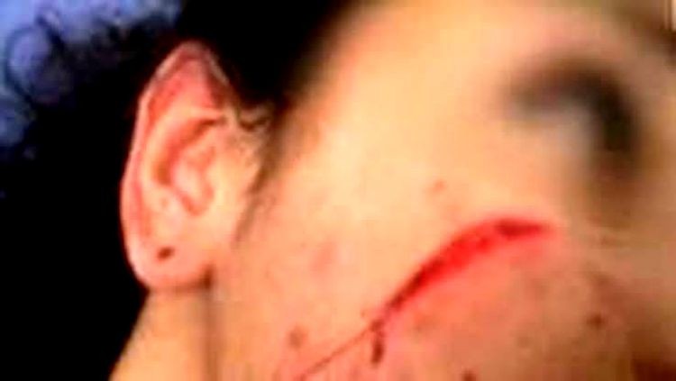 Mulher tem rosto cortado com estilete por rival que chegou procurando o marido