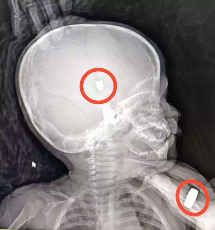 Bebê é baleado na cabeça em Ariquemes