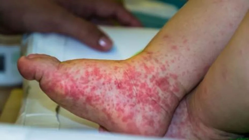 Gripe do tomate: entenda causas e sintomas da doença identificada
