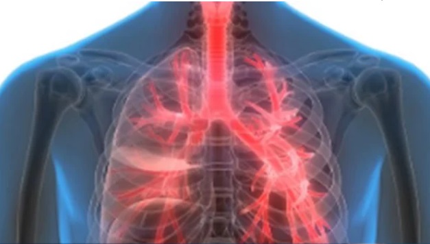 Bactéria legionella é causa de surto de pneumonia na Argentina