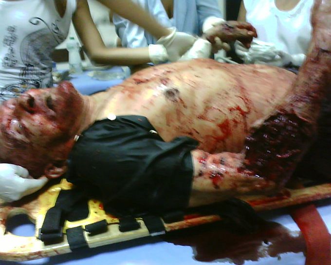 ATENÇÃO IMAGENS FORTES = Idoso que foi que atacado por pit bulls não resiste às mordidas e morre